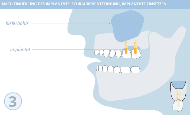 Knochenaufbau, Zahnimplantate, Dr. Desmyttère, Zahnarzt München 