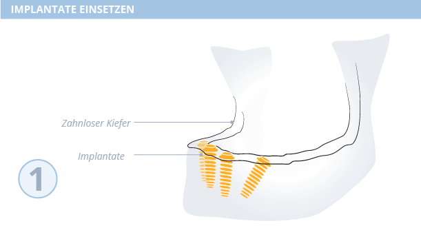All-on-4-Methode Zahnimplantate, Dr. Desmyttère, Zahnarzt München 