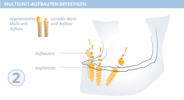 All-on-4-Methode Zahnimplantate, Dr. Desmyttère, Zahnarzt München 