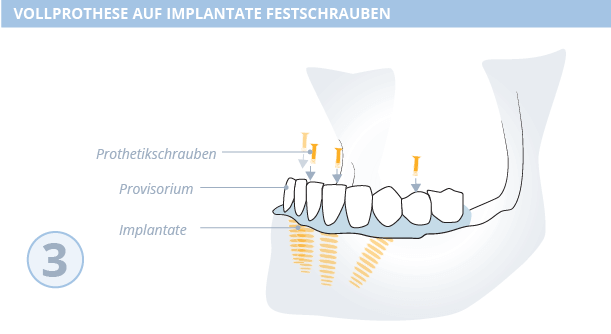 All-on-4-Methode Zahnimplantate, Dr. Desmyttère, Zahnarzt München 