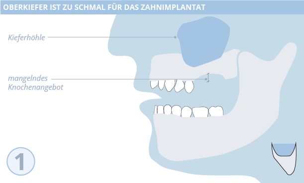 Knochenaufbau, Zahnimplantate, Dr. Desmyttère, Zahnarzt München 
