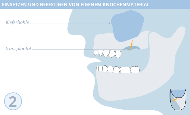 Knochenaufbau, Zahnimplantate, Dr. Desmyttère, Zahnarzt München 