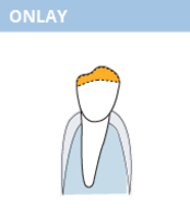Onlay, Zahnersatz, Dr. Desmyttère, Zahnarzt München