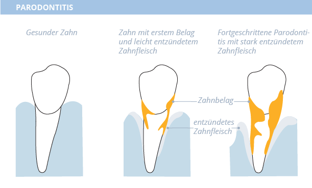 Parodontitis, allgemeine Zahnmedizin, Dr. Desmyttère, Zahnarzt München 