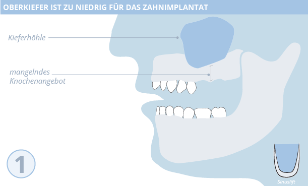 Sinuslift, Zahnimplantate, Dr. Desmyttère, Zahnarzt München 
