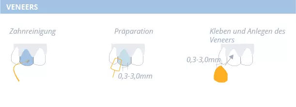 Veneers, Ästhetische Zahnmedizin, Dr. Desmyttère, Zahnarzt München 
