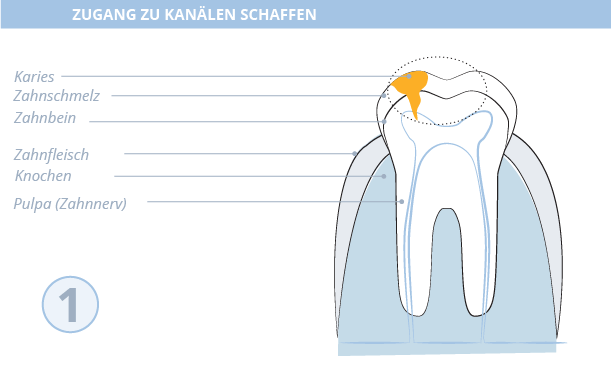 Wurzelkanalbehandlung, Dr. Desmyttère, Zahnarzt München