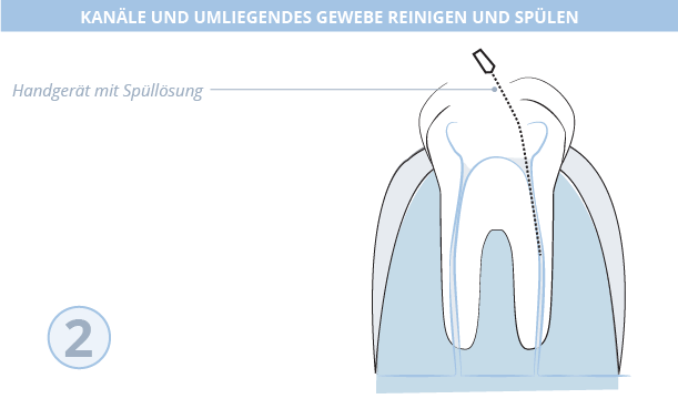 Wurzelkanalbehandlung, Dr. Desmyttère, Zahnarzt München