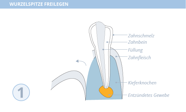 Wurzelspitzenresektion, Dr. Desmyttère, Zahnarzt München 