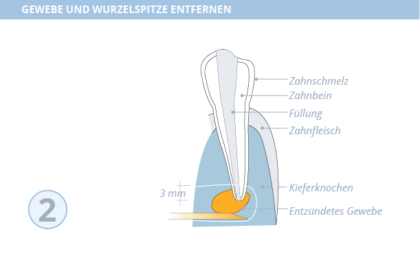 Wurzelspitzenresektion, Dr. Desmyttère, Zahnarzt München 