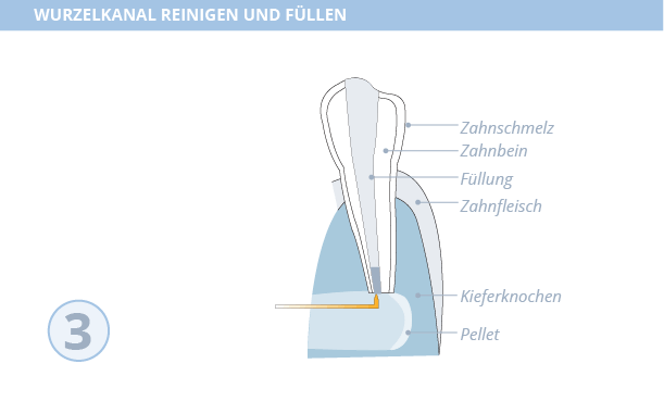 Wurzelspitzenresektion, Dr. Desmyttère, Zahnarzt München 
