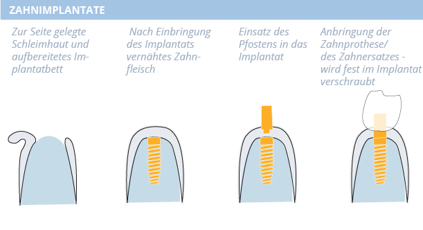 Zahnimplantat, Dr. Desmyttère, Zahnarzt München 